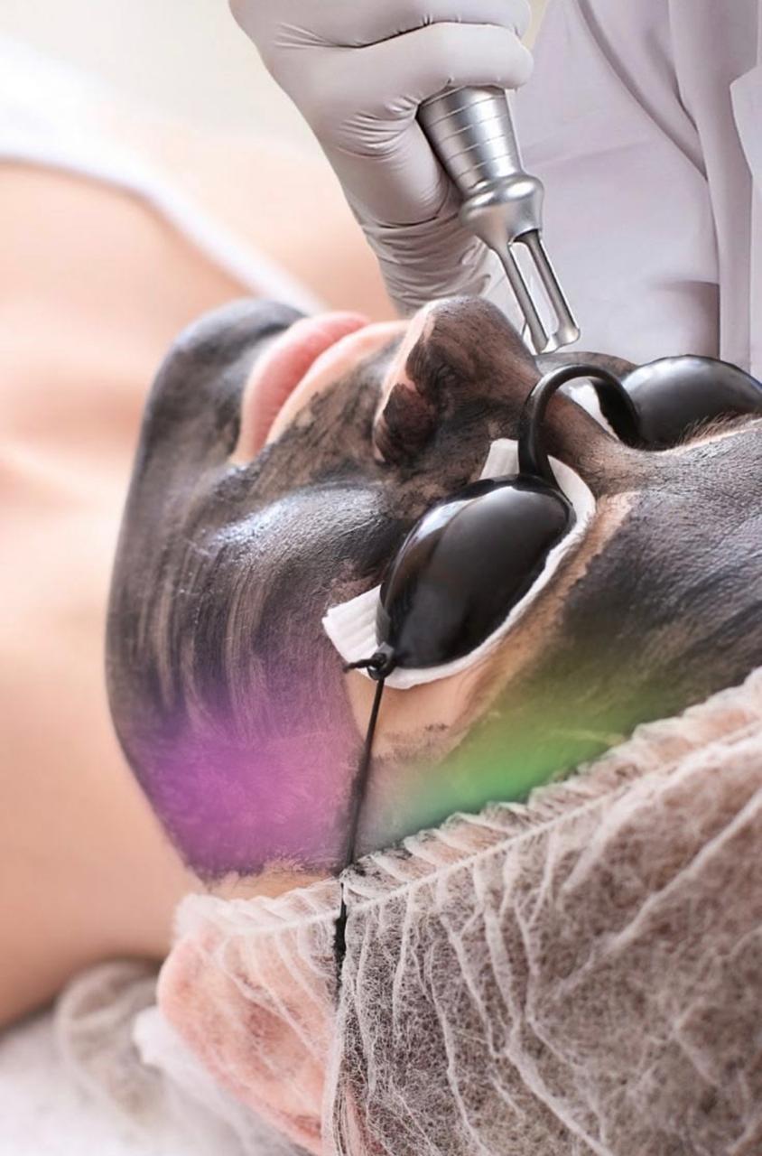 Peeling de carbón láser para afecciones de la piel